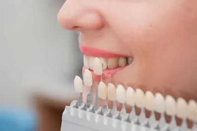 patient getting their teeth color-matched to their dental veneers