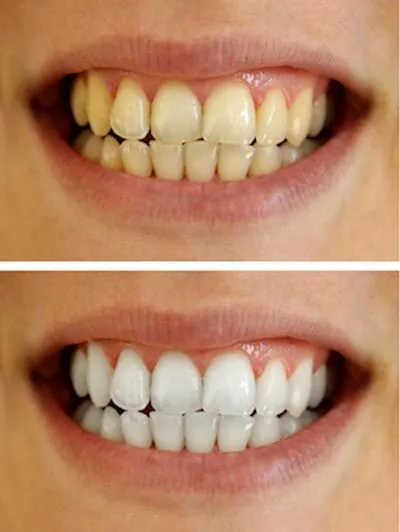 before and after teeth whitening at Hymas Family Dental