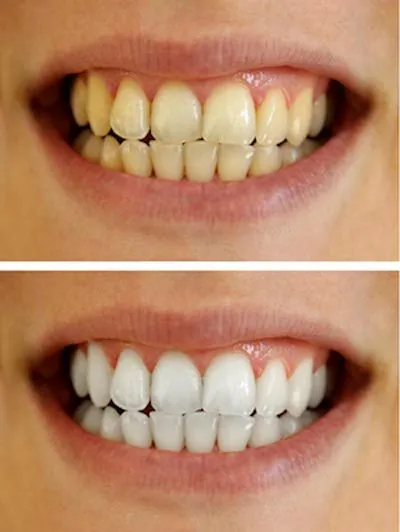 before and after teeth whitening at Hymas Family Dental in Spokane Valley, WA